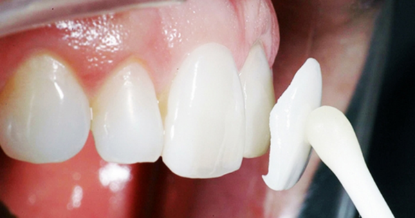 20200916-rang-su-veneer-1.png