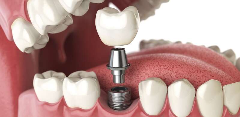CẤY GHÉP IMPLANT