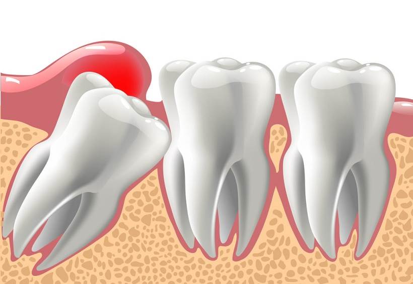 Răng khôn có tác dụng gì? Khi nào nên nhổ?